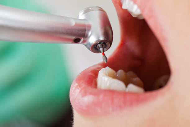 Best Emergency Tooth Extraction in Slayton, MN